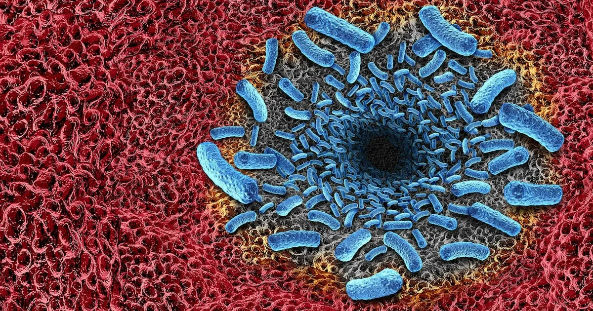 Bacteria carnívora ‘ataca’ costas en EU: ¿Qué sabemos de la primera muerte registrada en Florida
